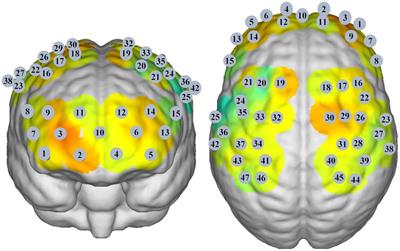 Functional connectivity alterations in the frontoparietal network and sensorimotor network are associated with behavioral heterogeneity in blepharospasm